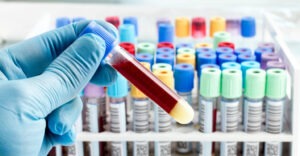 Serologic testing in Lyme disease